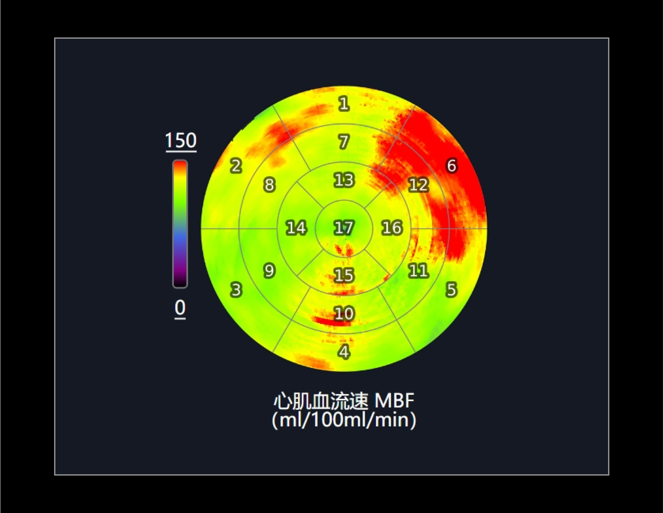 自动生成AHA17节段灌注参数牛眼图